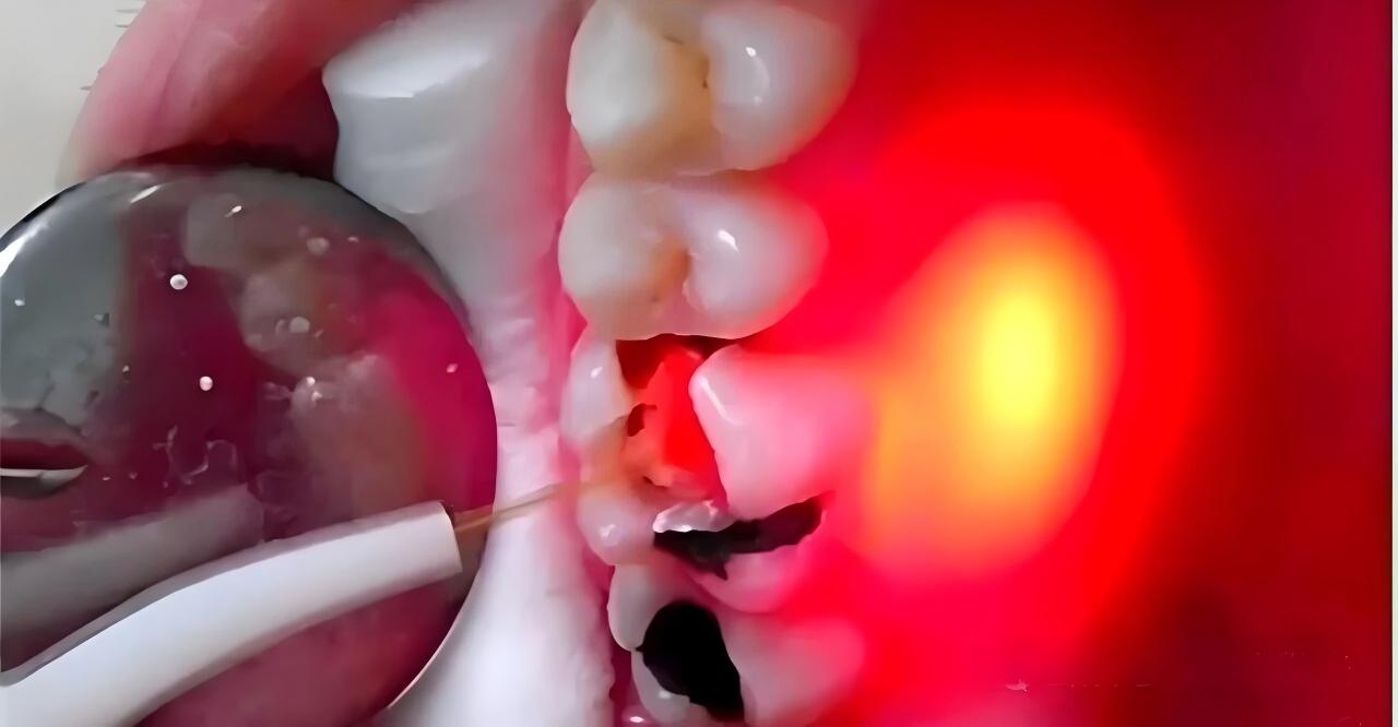 Dental Laser Equipment
