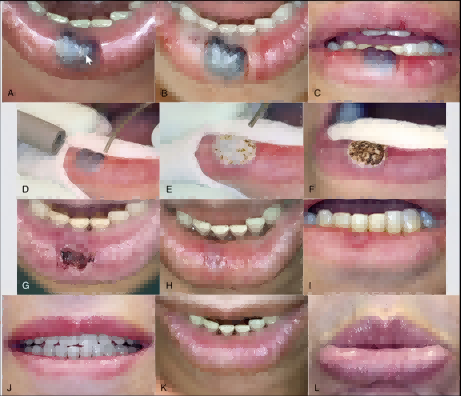 Dental Laser for Frenectomy