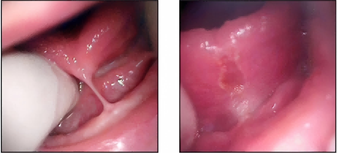 Dental Laser for Gingivectomy