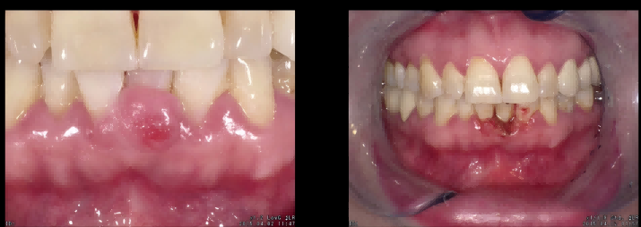 Dental Laser for Oral Surgery