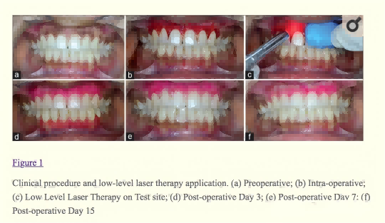 Dental Laser for Peri implantitis Treatment