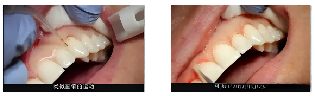 Dental Laser for Pocket Disinfection
