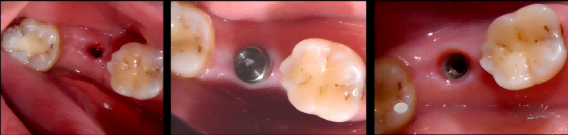 Dental Laser for Root Canal Disinfection