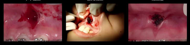 Dental Laser for Soft Tissue Surgery