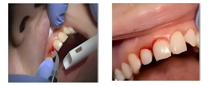 High Power Dental Laser
