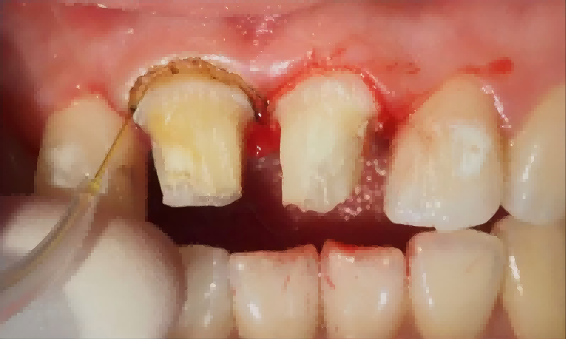 OEM Dental Laser Supplier