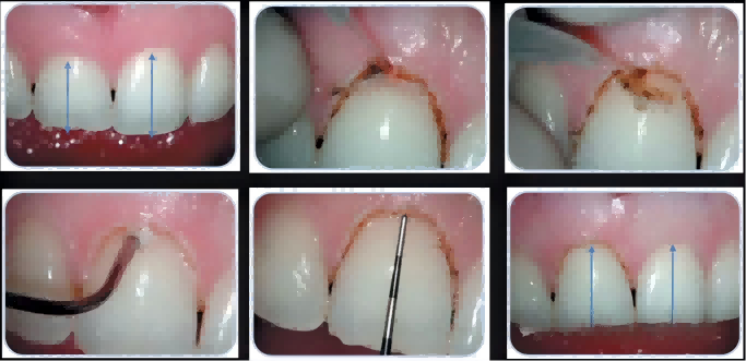 Portable Dental Laser Machine