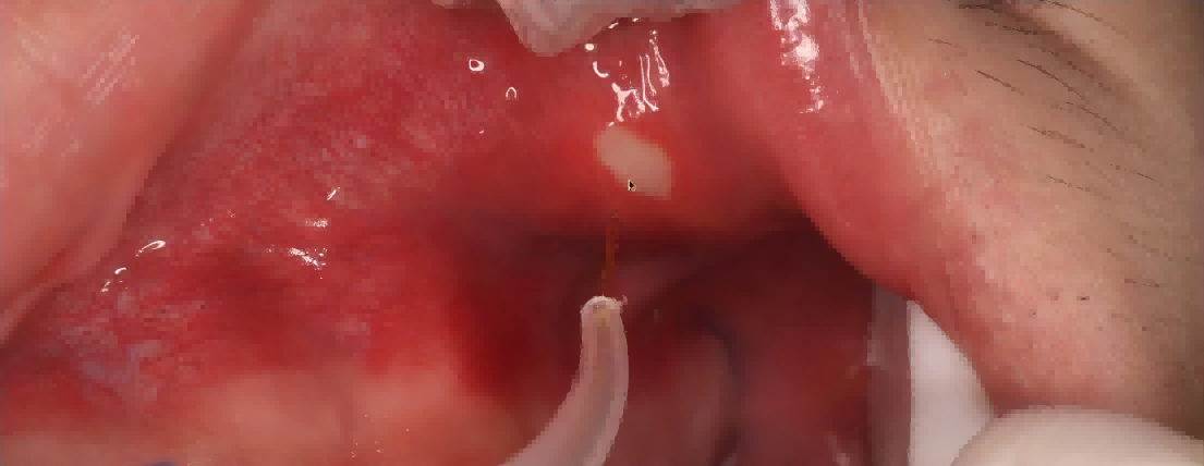 Soft Tissue Dental Laser